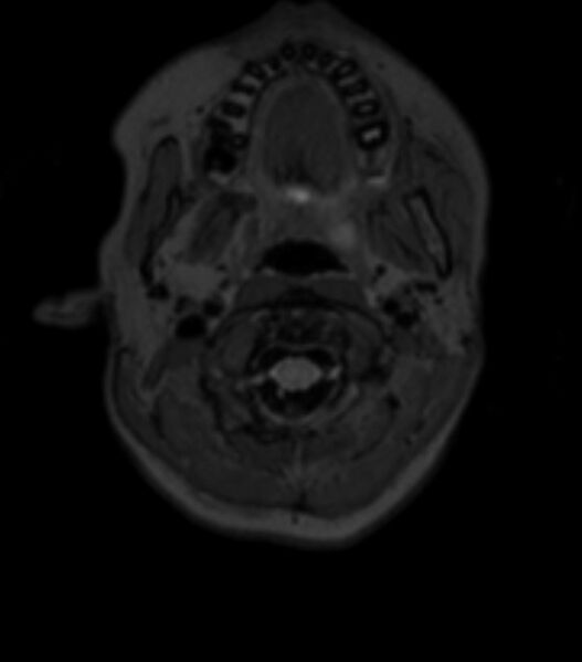 File:Choroid plexus carcinoma (Radiopaedia 91013-108553 Axial T2 fat sat 21).jpg