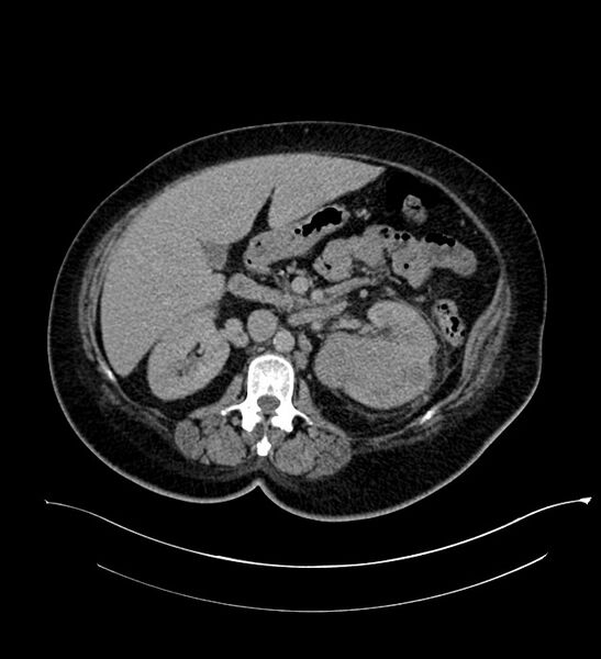 File:Chromophobe renal cell carcinoma (Radiopaedia 84239-99519 E 72).jpg