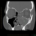 Chronic invasive fungal sinusitis with mycetoma (Radiopaedia 27430-27626 Coronal bone window 1).jpg