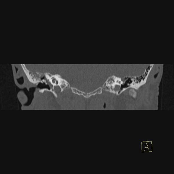 File:Chronic otitis media (Radiopaedia 14994-14912 Coronal bone window 13).JPEG
