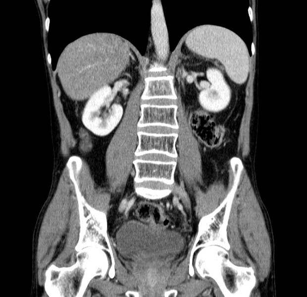 File:Chronic pancreatitis (Radiopaedia 23132-23172 C 38).jpg