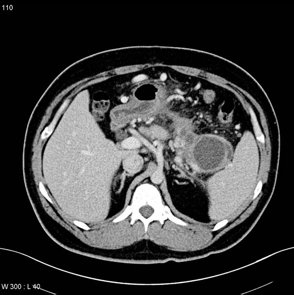 File:Chronic pancreatitis and pseudocysts (Radiopaedia 6724-7935 D 4).jpg