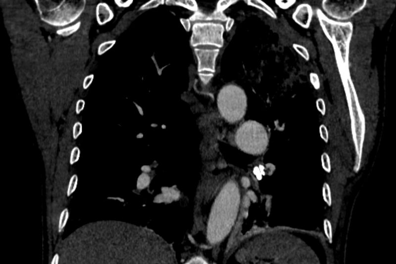 File:Chronic pulmonary embolism with bubbly consolidation (Radiopaedia 91248-108850 B 92).jpg