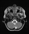 Chronic reactive multifocal osteomyelitis (CRMO) - mandible (Radiopaedia 56405-63069 Axial T2 21).jpg