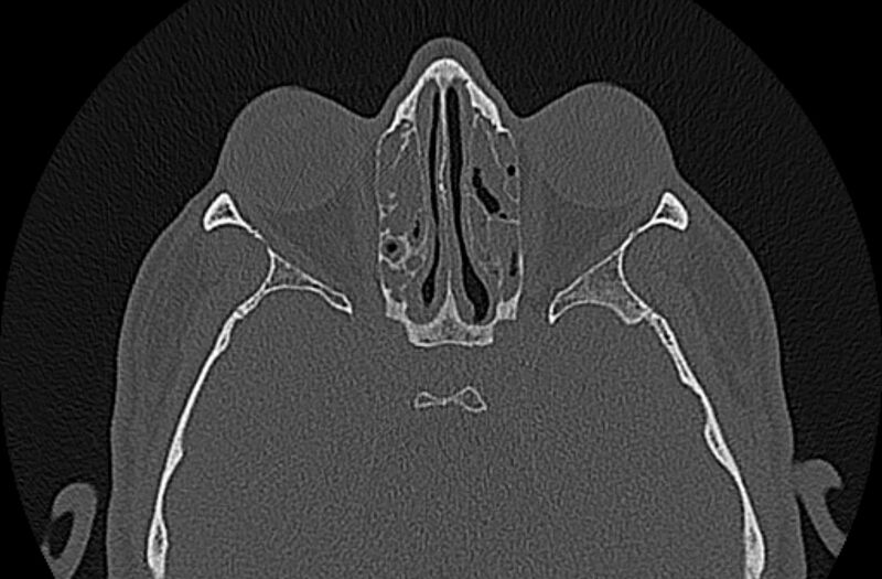 File:Chronic rhinosinusitis (Radiopaedia 65079-74075 Axial bone window 53).jpg