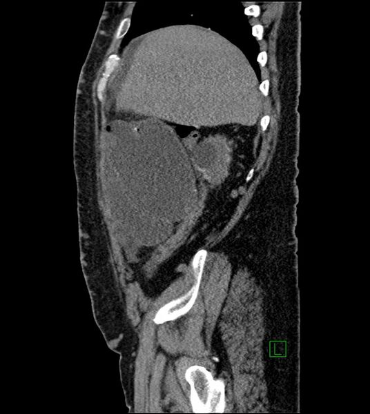 File:Closed-loop small bowel obstruction-internal hernia (Radiopaedia 78439-91096 C 114).jpg