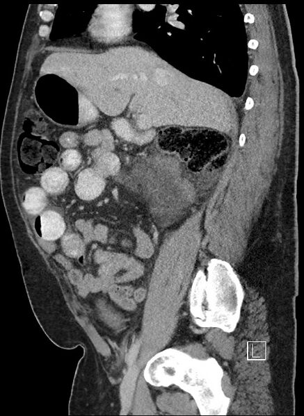 File:Closed loop obstruction - internal hernia into nephrectomy bed (Radiopaedia 59867-67320 C 63).jpg