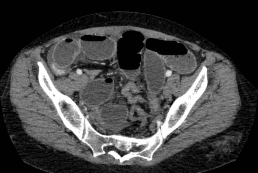 Closed loop small bowel obstruction (Radiopaedia 71211-81508 A 128).jpg