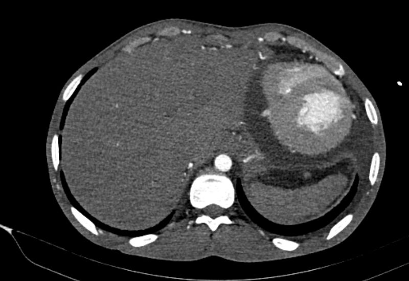 File:Coarctation of aorta with aortic valve stenosis (Radiopaedia 70463-80574 A 209).jpg