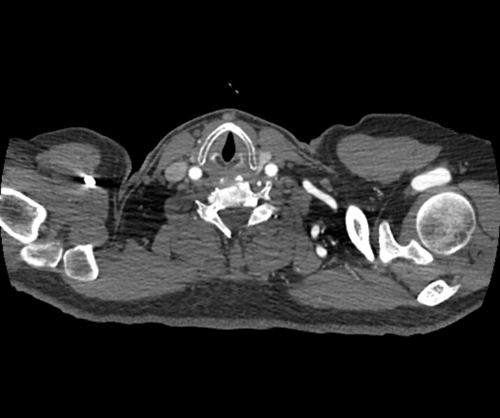 File:Coarctation of the aorta (Radiopaedia 53752-59822 A 6).jpg