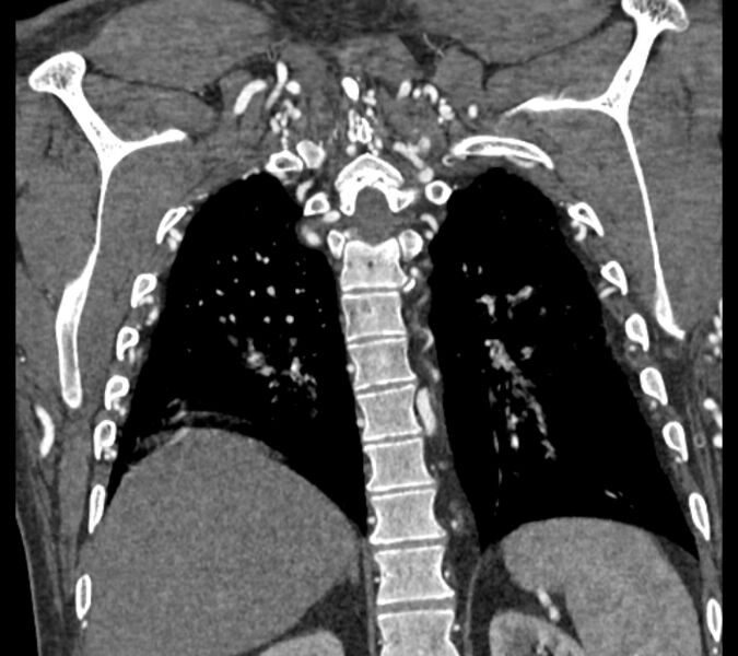 File:Coarctation of the aorta (Radiopaedia 53752-59822 B 61).jpg