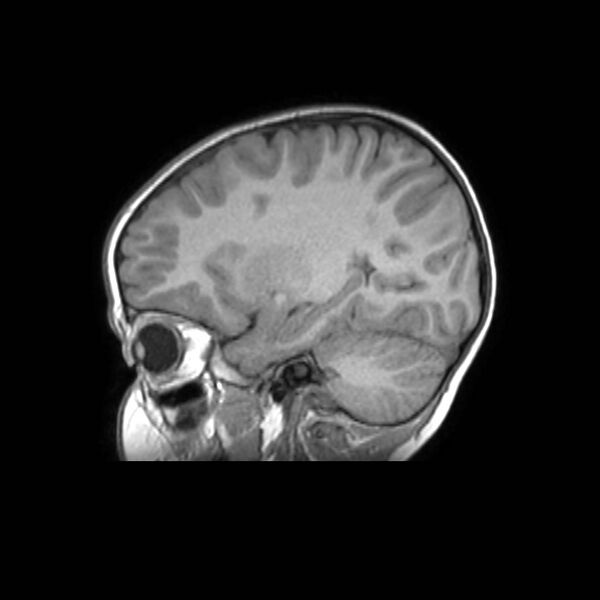 File:Cochlear nerve aplasia - unilateral (Radiopaedia 87910-104413 Sagittal T1 17).jpg