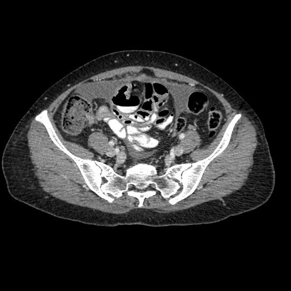 File:Cocoon abdomen with possible tubo-ovarian abscess (Radiopaedia 46235-50636 A 34).png