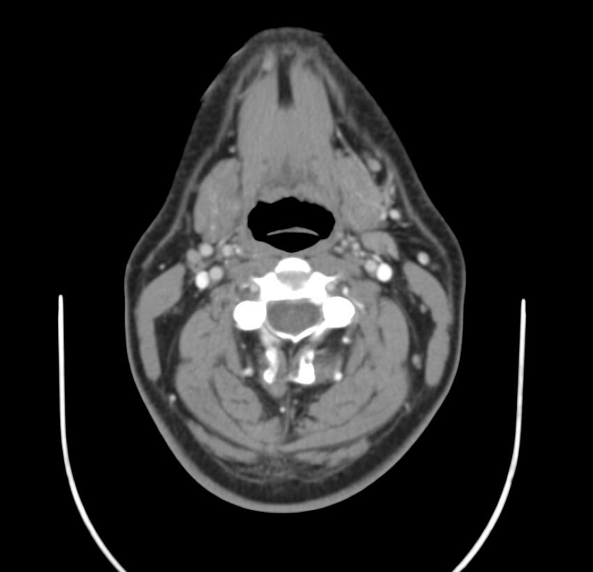 Colloid cyst of thyroid (Radiopaedia 22897-22923 Axial C+ delayed 34).jpg