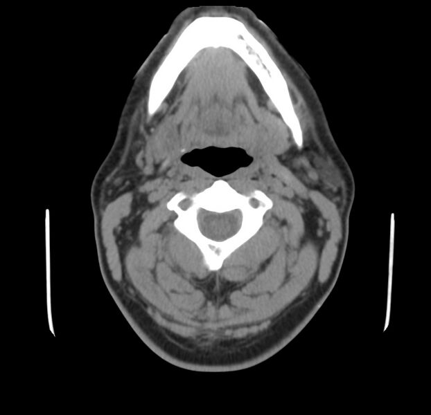 File:Colloid cyst of thyroid (Radiopaedia 22897-22923 Axial non-contrast 20).jpg