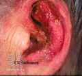 Dermatitis (DermNet NZ dermatitis-s-otitis2).jpg