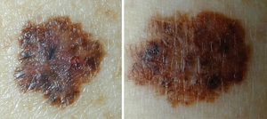 Dysplastic nevus and melanoma.png