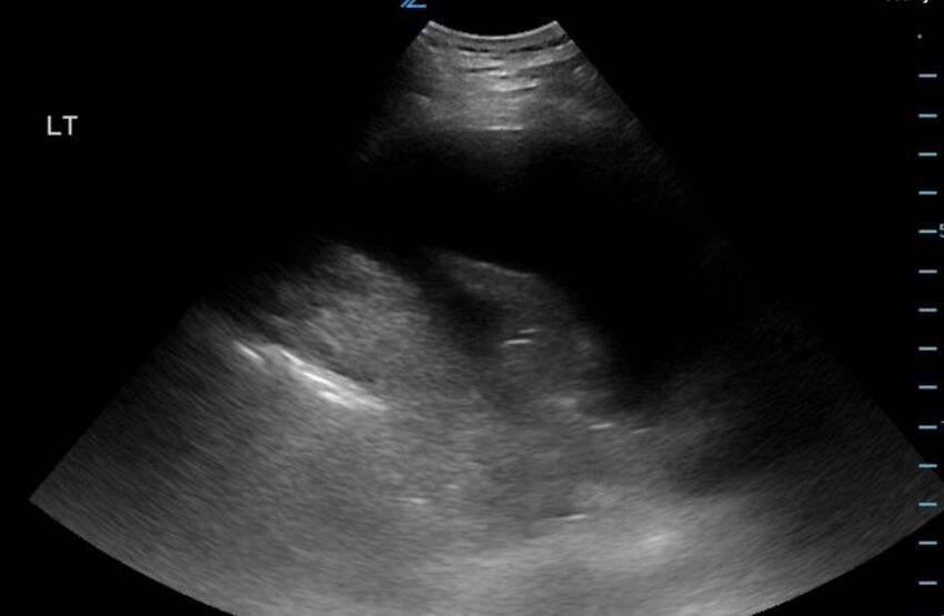 Figure 9.11B Passive Atelectasis – Ultrasound, large pleural effusion with atelectasis.jpg
