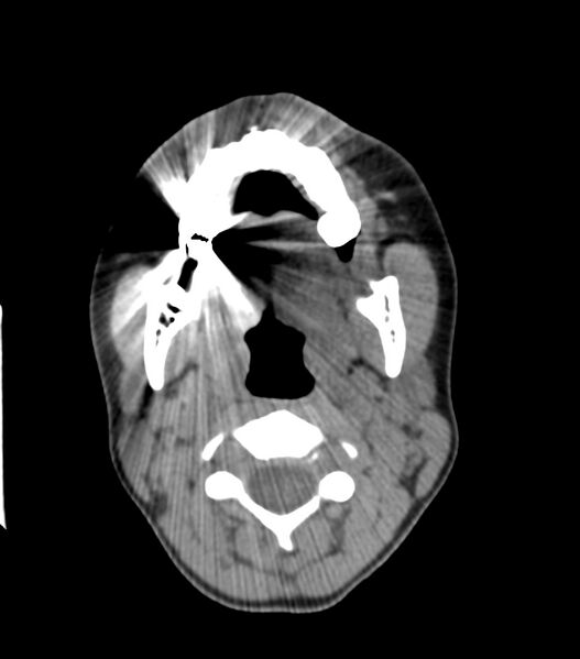File:Nasoorbitoethmoid fracture (Radiopaedia 90044-107205 Axial non-contrast 84).jpg
