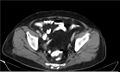 Necrotizing pancreatitis (Radiopaedia 20595-20495 A 39).jpg