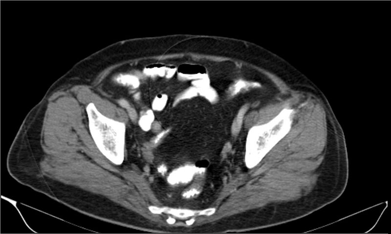 File:Necrotizing pancreatitis (Radiopaedia 20595-20495 A 39).jpg