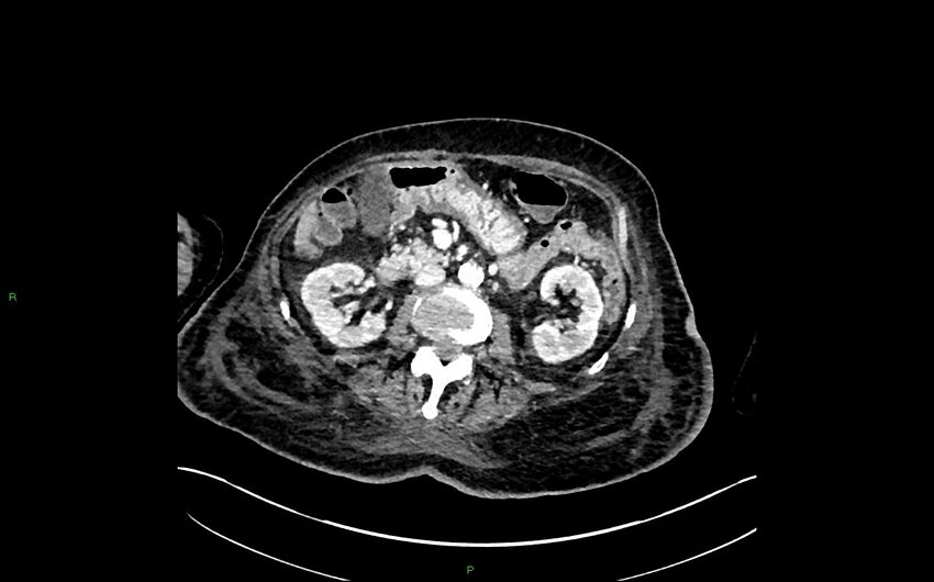 Neo-terminal ileal stricture (Crohn disease) (Radiopaedia 33790-34948 A 183).jpg