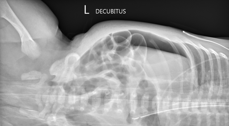 File:Neonatal gastric perforation (Radiopaedia 41871-44874 Decubitis 1).png