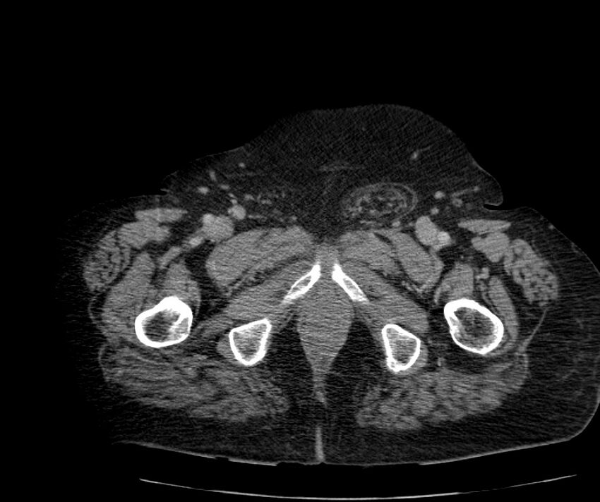 Nephroptosis with inguinal hernia containing perirenal fat (Radiopaedia 56632-63391 C 343).jpg