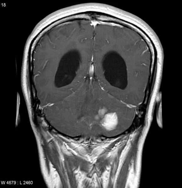 File:Neurofibromatosis type 2 - cranial and spinal involvement (Radiopaedia 5351-7111 Coronal T1 C+ 11).jpg