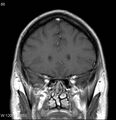 Neurosarcoidosis (Radiopaedia 10930-17204 Coronal T1 C+ 4).jpg