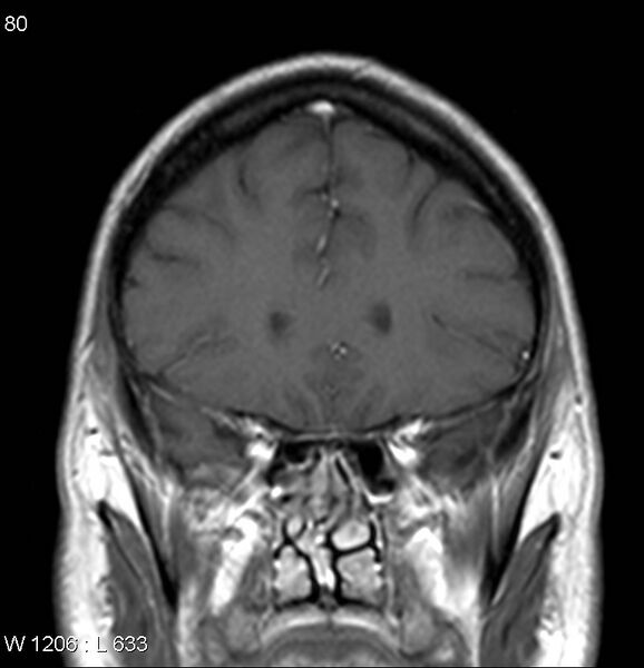 File:Neurosarcoidosis (Radiopaedia 10930-17204 Coronal T1 C+ 4).jpg