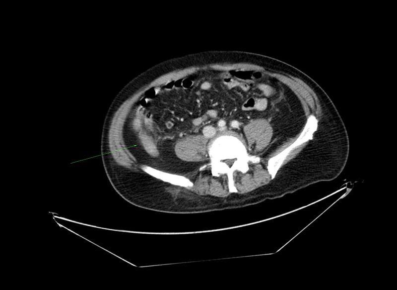 File:Non-Hodgkin lymphoma involving seminal vesicles with development of interstitial pneumonitis during Rituximab therapy (Radiopaedia 32703-33677 Annotated CT 5).jpg