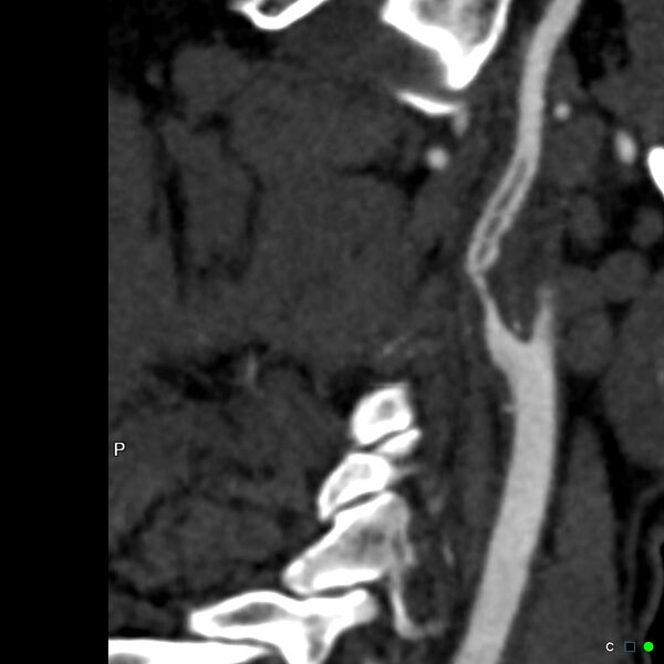 File:Non-occlusive intraluminal internal carotid artery thrombus (Radiopaedia 37751-39658 A 23).jpg