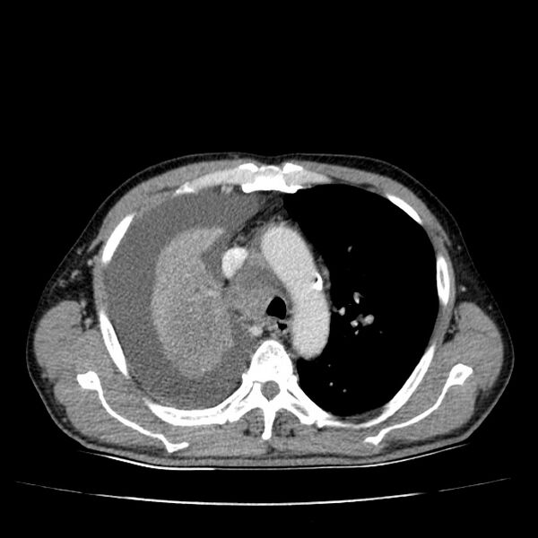 File:Non small-cell lung cancer (Radiopaedia 24467-24769 C+ delayed 22).jpg
