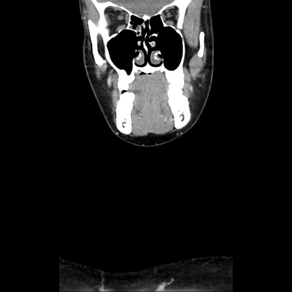 File:Normal CT of the neck (Radiopaedia 14575-14500 Coronal C+ 12).jpg