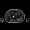 Normal MRI abdomen in pregnancy (Radiopaedia 88001-104541 Axial Gradient Echo 10).jpg
