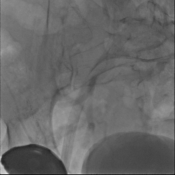File:Normal cerebral angiogram (four vessel DSA) (Radiopaedia 41708-44649 Ref 1).png