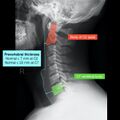 Normal cervical spine radiographs (Radiopaedia 32505-96698 Lateral 4).jpeg