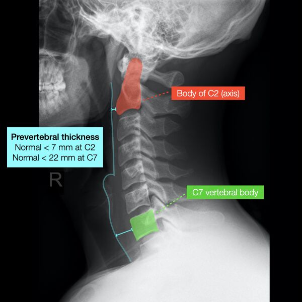 File:Normal cervical spine radiographs (Radiopaedia 32505-96698 Lateral 4).jpeg