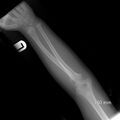 Normal elbow x-ray - 5-year-old (Radiopaedia 53080-59040 Frontal 1).jpg