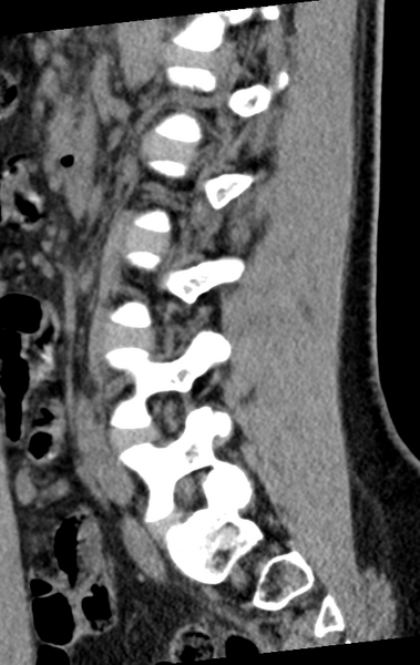 File:Normal lumbar spine CT (Radiopaedia 46533-50986 C 38).png