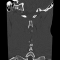 Normal trauma cervical spine (Radiopaedia 41017-43760 Coronal bone window 34).png