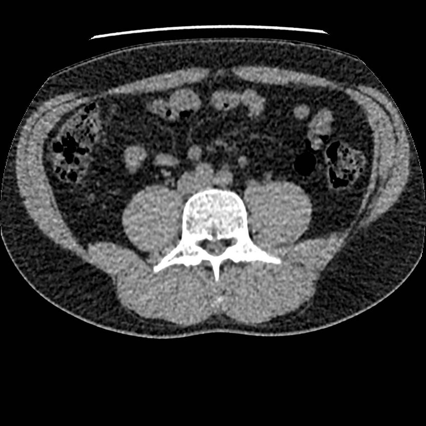 Obstructing ureteric calculus and ureteric anatomy (Radiopaedia 62730-71042 Axial non-contrast 84).jpg