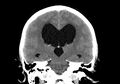Obstructive hydrocephalus (Radiopaedia 30453-31119 Coronal non-contrast 22).jpg