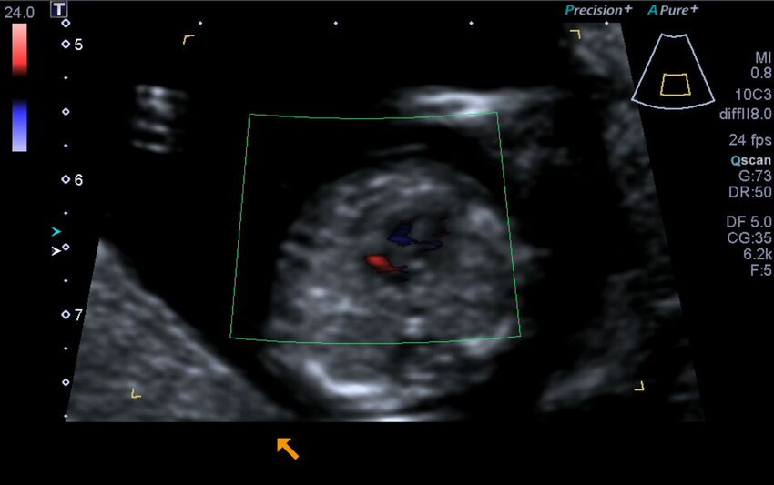 1st trimester nuchal-morphology ultrasound (Radiopaedia 44706-48477 Heart views cine with colour 106).jpg