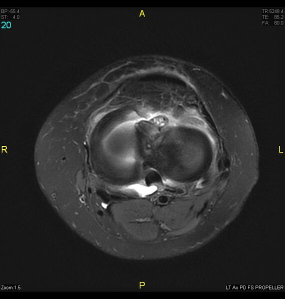 File:ACL mucoid degeration with cystic changes (Radiopaedia 48428-53341 Axial PD fat sat 17).jpg