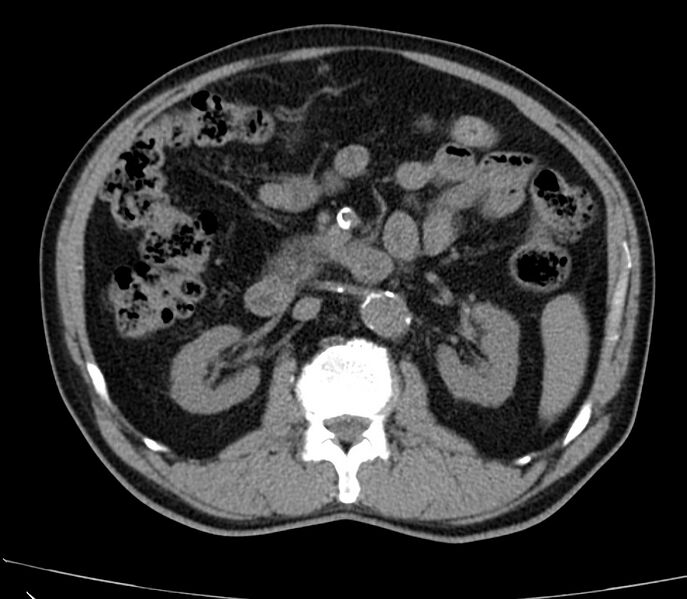 File:Abdominal aortic aneurysm (Radiopaedia 22421-22458 non-contrast 22).jpg