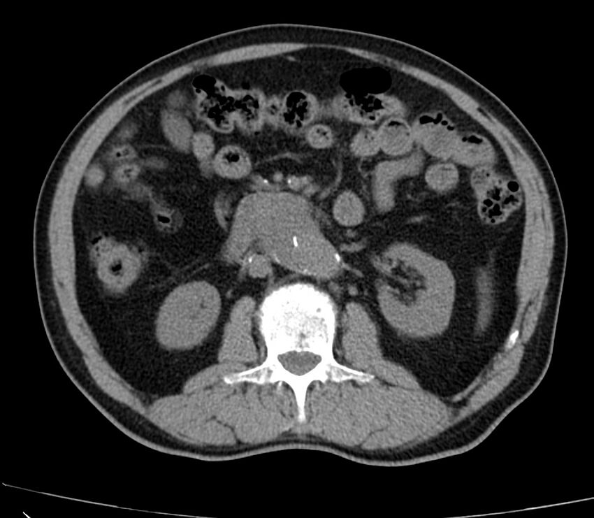 Abdominal aortic aneurysm (Radiopaedia 22421-22458 non-contrast 24).jpg
