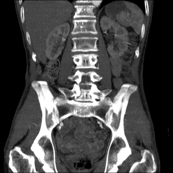 File:Abdominal aortic aneurysm (Radiopaedia 23703-23856 Coronal C+ arterial phase 22).jpg