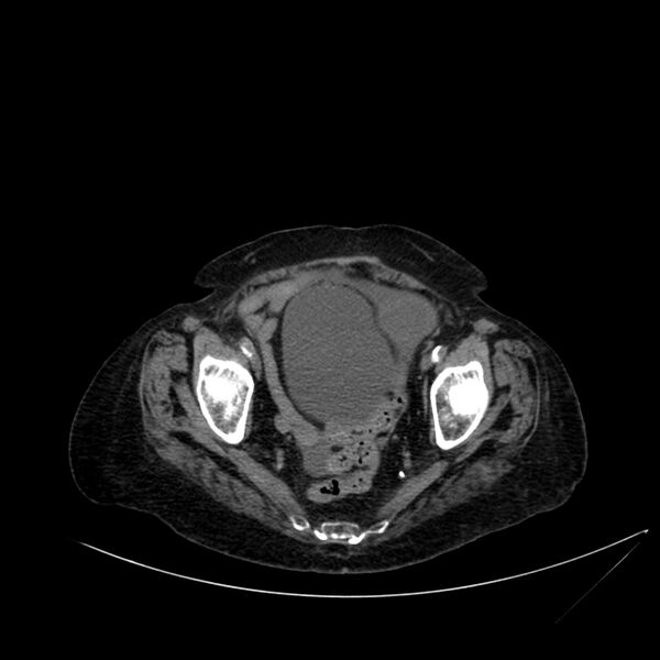 File:Abdominal aortic aneurysm - impending rupture (Radiopaedia 19233-19246 Axial non-contrast 109).jpg